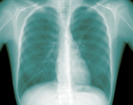 Radiographie des poumons - Agrandir l'image (fenêtre modale)